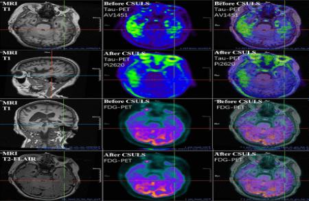 A simple neck surgery is raising hopes for Alzheimer’s disease patients