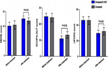 Donepezil combined with nerve growth factor in Parkinson’s disease dementia