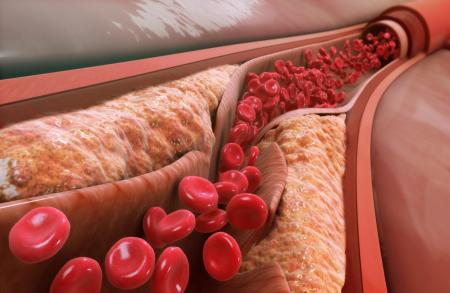 Blood Lipoprotein Levels and Alzheimer Disease